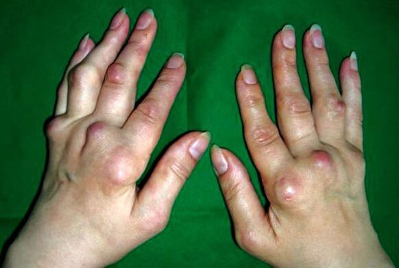 Ruky postihnuté polyosteoartritídou deformans
