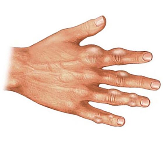 Ukladanie kryštálov kyseliny močovej v mäkkých tkanivách prstov s dnavou artritídou