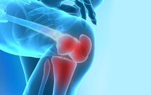 ako sa prejavuje artróza kolenného kĺbu