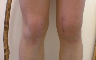 štádia vývoja artrózy kolena