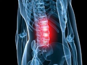 Osteochondróza bedrovej chrbtice