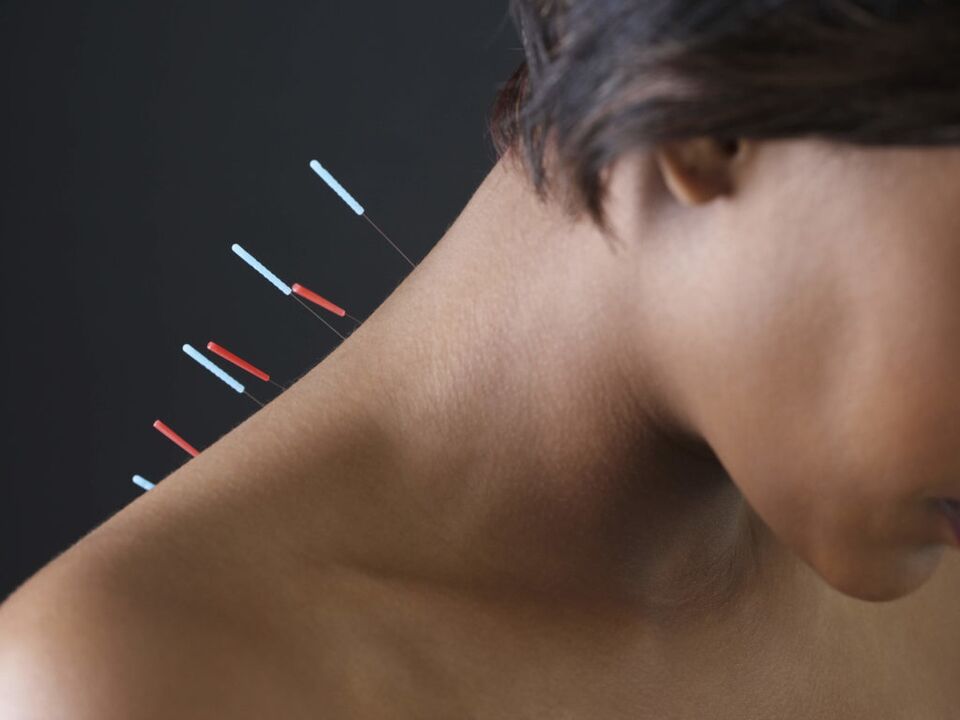 Akupunktúra pre cervikálnu osteochondrózu odstraňuje zápalové procesy