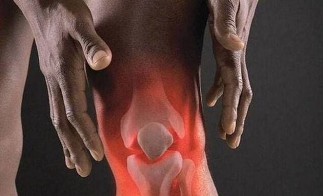 Artróza je sprevádzaná zápalovým procesom v kolennom kĺbe