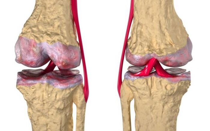 Artróza kolenného kĺbu